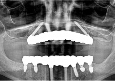 Upper and lower fixed zirconia bridges