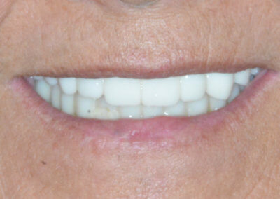 Upper fixed bridge on 5 implants