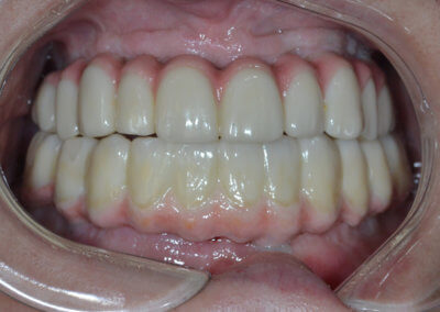 Upper and lower fixed zirconia bridges