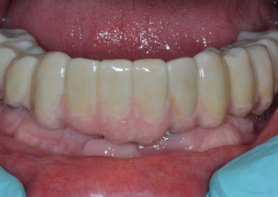 Lower fixed bridge on implants