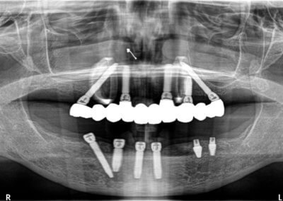 Upper fixed bridge on 5 implants