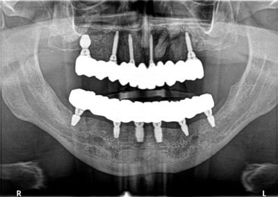 Upper and lower fixed zirconia bridges