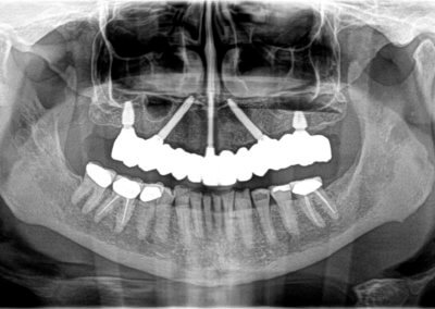 Upper fixed bridge on implants