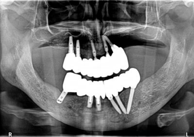 Upper and lower fixed zirconia bridges