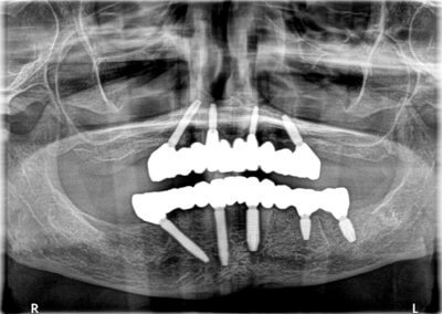 Upper and lower fixed bridges on implants