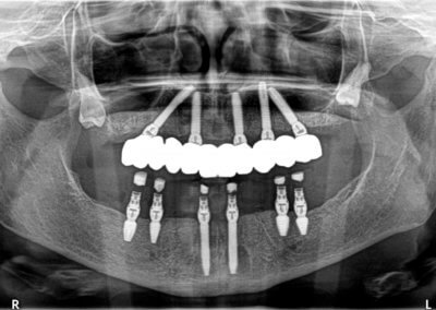 Upper fixed bridge on 5 implants