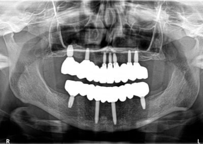 Upper and lower fixed zirconia bridges on implants