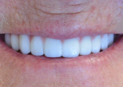 Upper fixed zirconia bridge on 5 implants