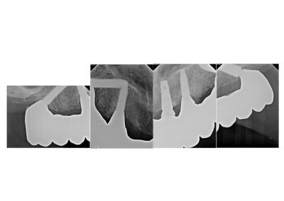 Upper fixed zirconia bridge on 5 implants