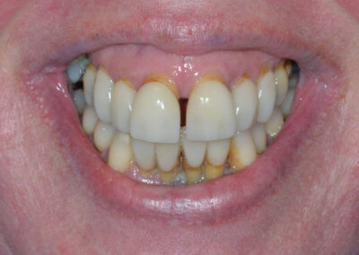 Upper and lower fixed zirconia bridges on implants