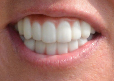 Upper and lower fixed zirconia bridges on implants