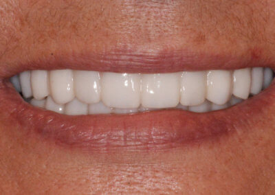 Upper and lower fixed zirconia bridges on four implants