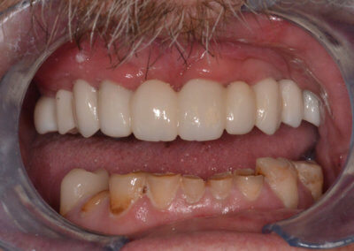 Upper 10 teeth zirconia bridge on 5 implants
