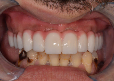 Upper 12 teeth zirconia bridge on 4 implants