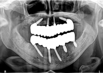 Upper and lower fixed zirconia bridges on implants