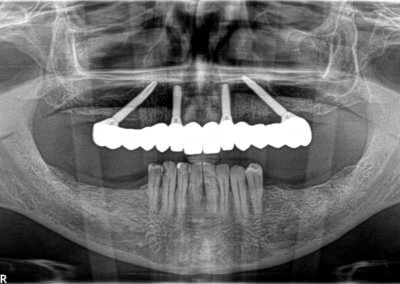 Upper 12 teeth zirconia bridge on 4 implants