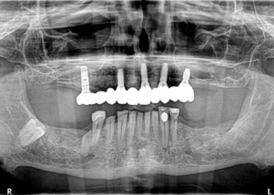 10 teeth zirconia bridge on 5 implants