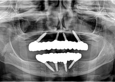 Upper and lower fixed zirconia bridges on four implants