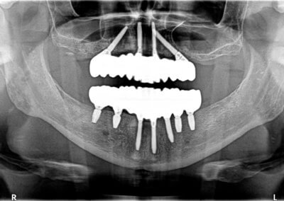 Upper and lower fixed zirconia bridges