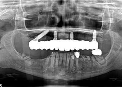 Upper fixed bridge on 4 implants