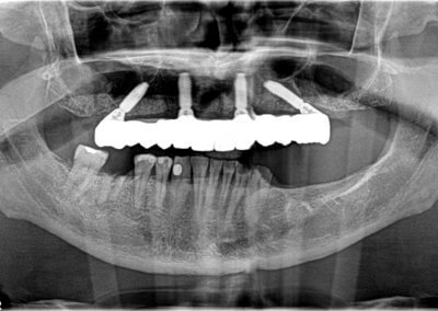 Upper fixed bridge on 4 implants