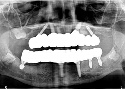 Lower fixed bridge on 5 implants