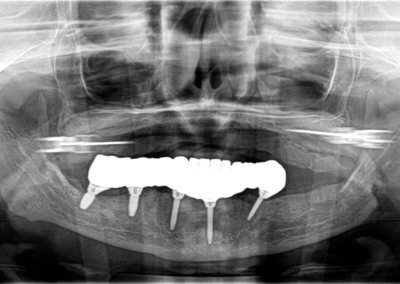 Lower zirconia bridge on five implants