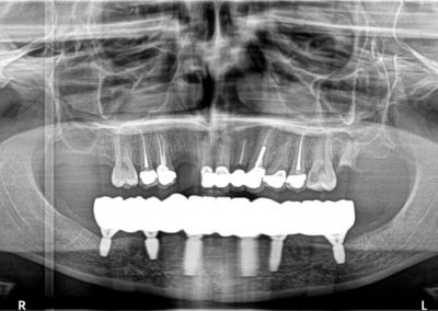 Lower zirconia bridge on six implants