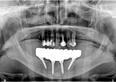 Lower zirconia bridge on four implants