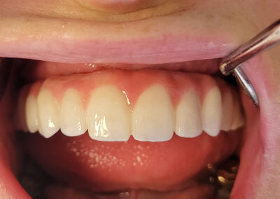 Upper fixed bridge on 4 implants