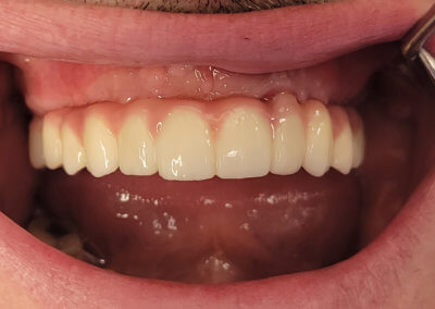 Upper fixed bridge on 4 implants