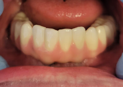 Lower fixed bridge on 5 implants