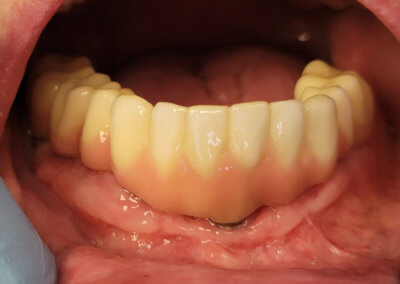 Lower zirconia bridge on five implants