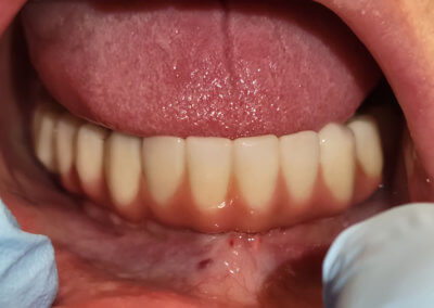 Lower zirconia bridge on six implants