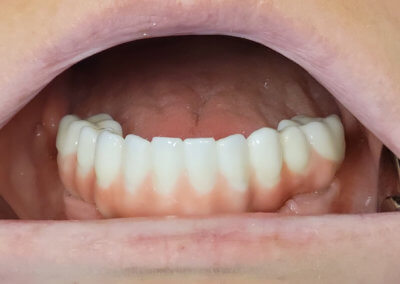 Lower zirconia bridge on four implants