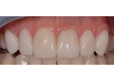 Four upper porcelain veneers