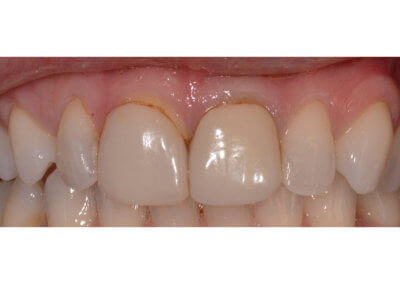 Four upper porcelain veneers