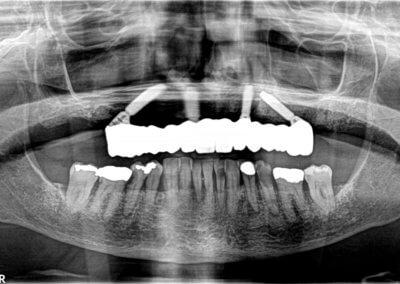 Upper fixed bridge on 4 implants