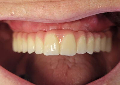 Upper fixed bridge on 4 implants