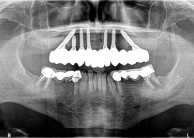 Upper fixed bridges on 7 implants