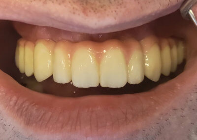 Upper fixed bridges on 7 implants