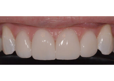 Four upper porcelain veneers