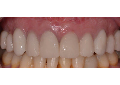 Ten upper porcelain crowns