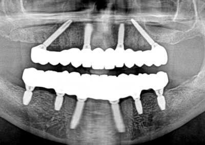 Upper and lower fixed bridges on implants
