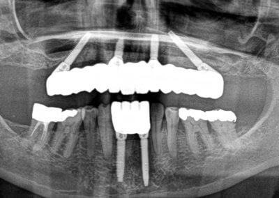 Upper and lower fixed bridges on implants