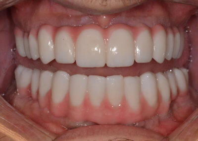 Upper and lower fixed bridges on implants