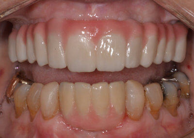 Upper and lower fixed bridges on implants