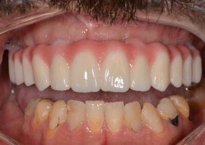 Upper all-on-four zirconia bridge