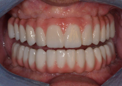 Upper and lower fixed zirconia bridges on implants