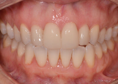 Four upper porcelain veneers